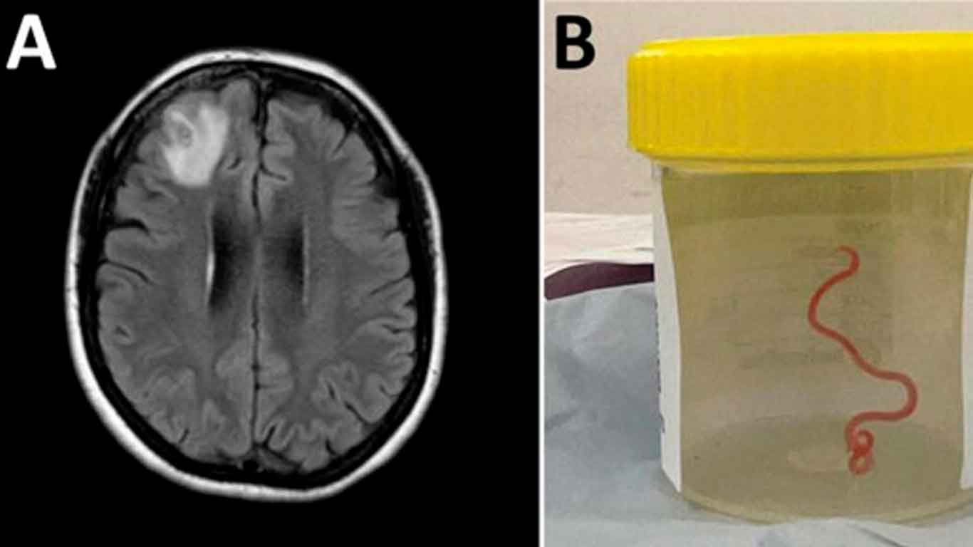 Increíble: Extraen Gusano Vivo del Cerebro de Mujer Australiana